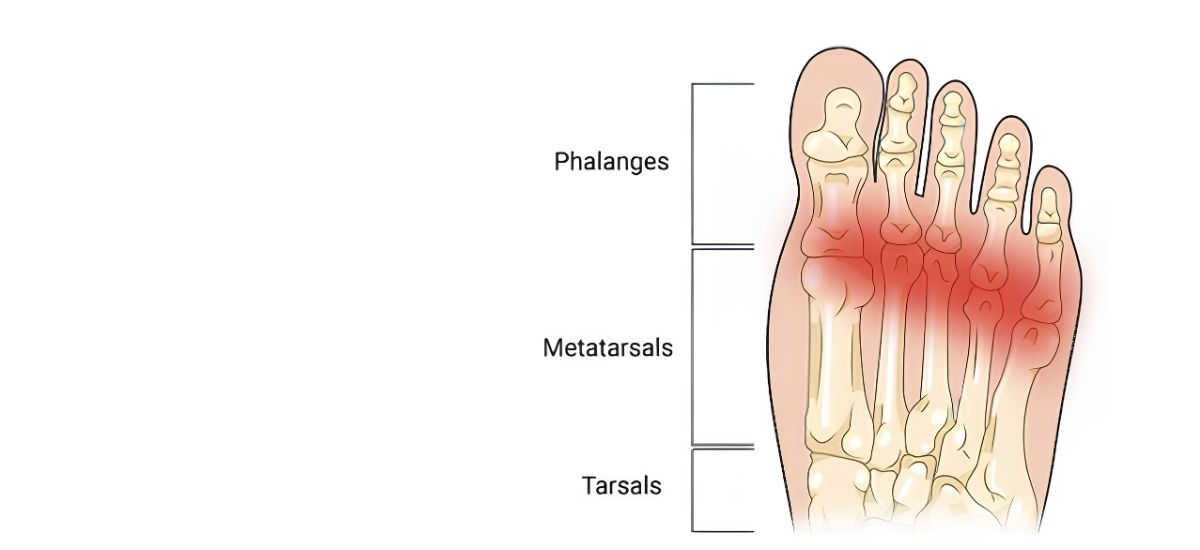 Metatarsalgia